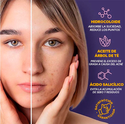 StarGlow® Set de Parches Anti-Acné | 🎁PAGA 1 LLEVA 2🎁